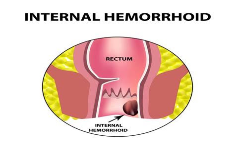hemorrhoids overview symptoms causes types diagnosis