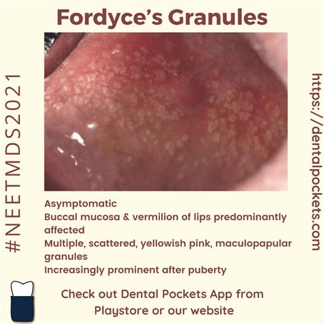 fordyces granules dental pockets blog