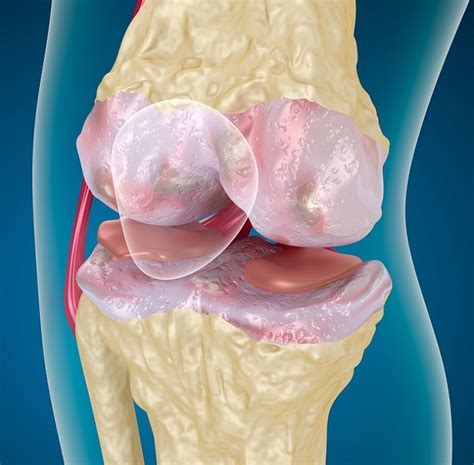 Fda Approves Durolane To Treat Knee Osteoarthritis Pain Rheumatology
