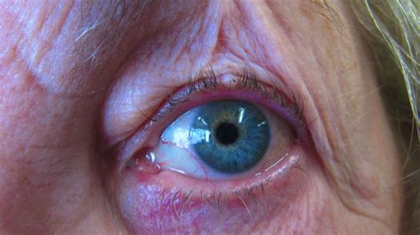 treatment  lump  eyelid chalazion eyelid cyst  david cheung eyelid specialist
