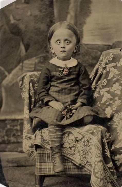 Ca 1865 [unidentified Girl With Hydrocephalus