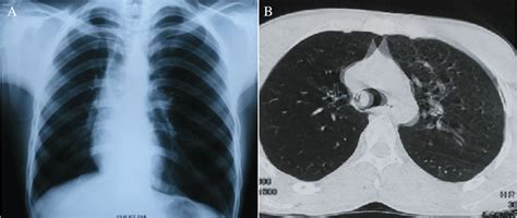 Chest X Ray P A View Showing The Right Upper Lobe Collapse A And A