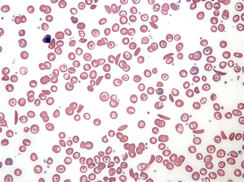 sickle cell disease  hematologist understand hematology