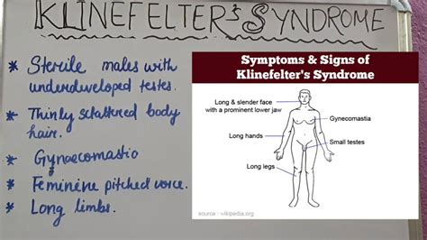 These Are The Symptoms Of Klinefelters Syndrome Medizzy Sexiezpicz