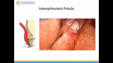 first aid toolkit for anal fistulas a detailed treatise for trainees escp trainee video youtube