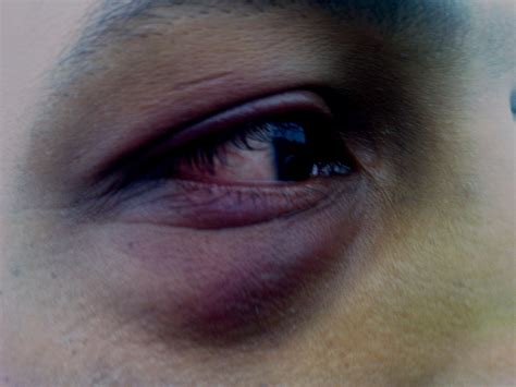 black eye   signs symptoms  home remedies
