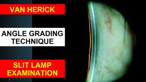van herick slit lamp technique angle grading technique anterior