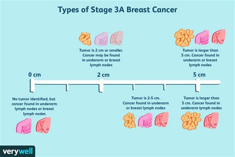 Stage 3 Breast Cancer Types Treatment Survival