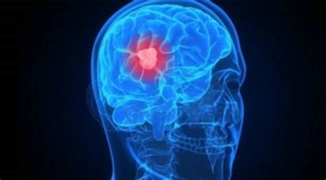 new way to treat aggressive brain tumour identified the indian express