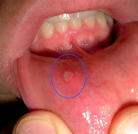 mouth ulcer wikipedia