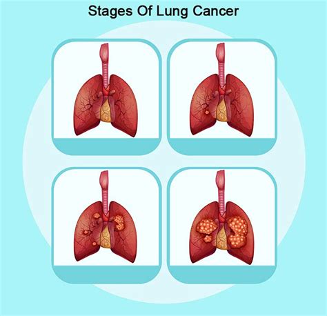 lung cancer symptoms causes stages and treatment