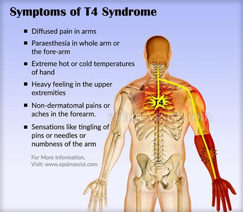 T4 Syndrome Signs Symptoms Causes Treatment Recovery