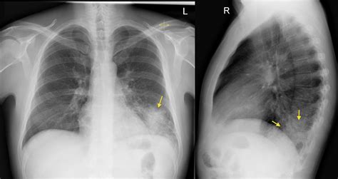 left  lobe pneumonia lateral cxr radiology  st vincents