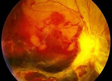 diabetic retinopathy norway   case reports symptoms