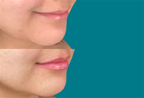 beautiful lip filler   angell medical spa