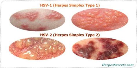 genital herpes pictures and symptoms genital herpes