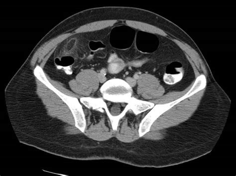 ct scan of the abdomen pelvis cedars sinai