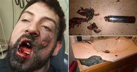 man s face blown up after e cigarette explodes while he s smoking it metro news