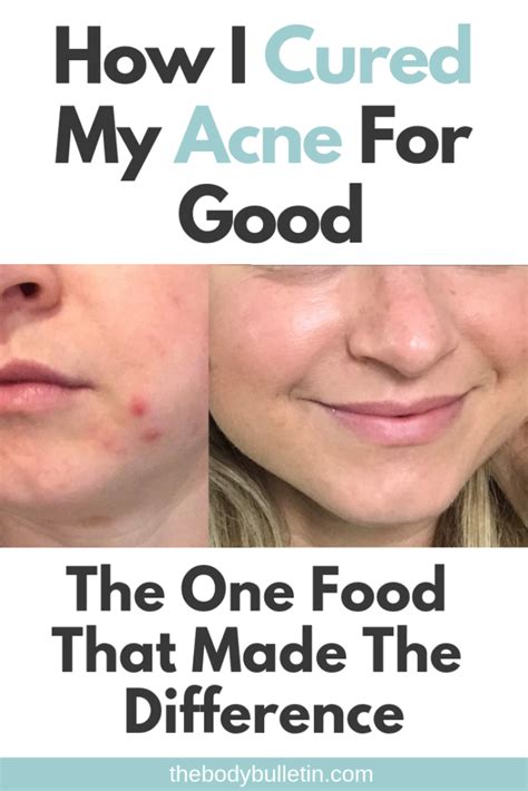 Is Dairy The Cause Of Acne Heres My Before And After Proof • The Body
