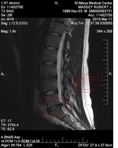 Herniated Disc At L5 S1 Advice Mri Included Injuries