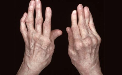 Mano Artritis Síntoma Tratamiento Y Ejercicio Saludaio
