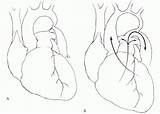 Coarctation Aorta sketch template