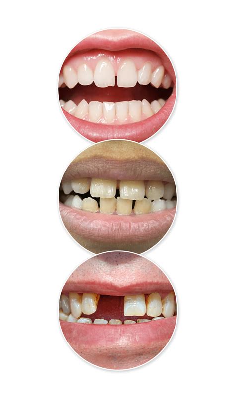 gap in teeth
