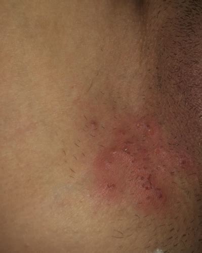 what does it look like razor bump folliculitis or std sexual