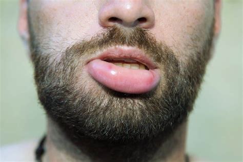 What Causes Swollen Lips And Eyes