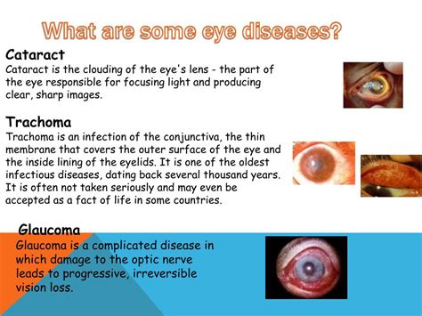 Ppt The Eye Powerpoint Presentation Free Download Id 2160688