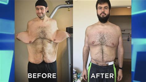 Man Who Lost Over 300 Pounds Returns After Skin Removal Surgery The