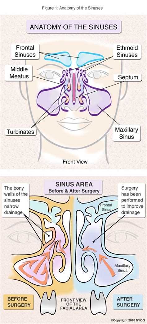 sinusitis treatment  surgery nyc