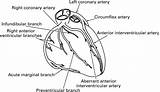 Heart Coronary Tetralogy Fallot sketch template