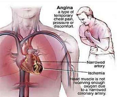 blocked artery symptoms silent heart attacks hubpages