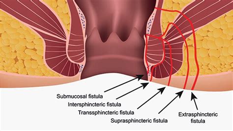 fistulas        common side effect  crohns