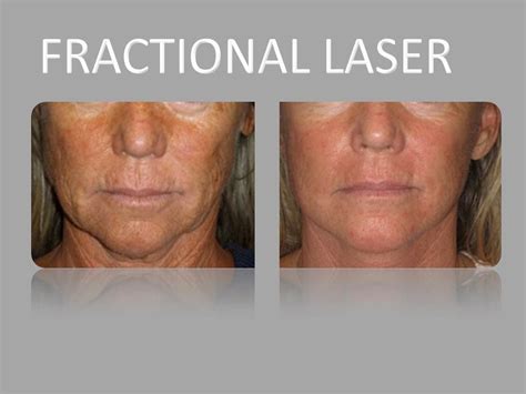 labeling ablative  laser resurfacing recovery