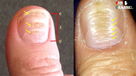 horizontal ridges  toenails  symptoms prevention remedies treatment