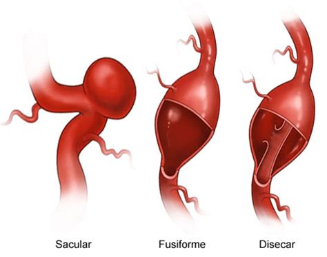 aneurisma cerebral en ninos sintomas  tratamiento