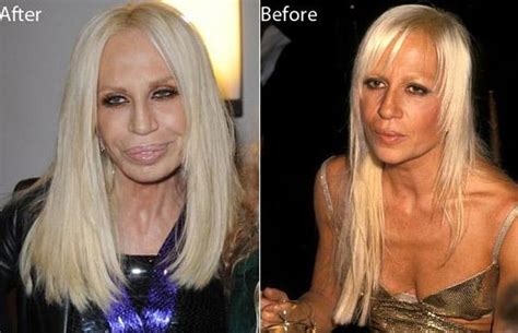 Donatella Versace After And Before Plastic Surgery Celebrity Plastic