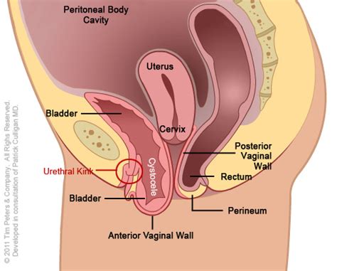 Cystocele With Uterus Image 4 Gynecologic
