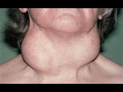 thyroid goiter treatments enlargement   thyroid youtube