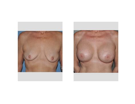 women with polypropylene breast implants