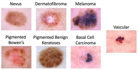 skin lesion classification agnieszka mikolajczyk