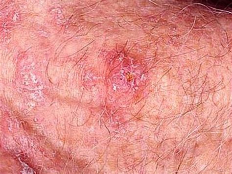 Melanoma The Deadliest Skin Cancer Skin Cancer Or Mole How To Tell