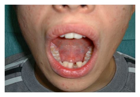 Dermoid Cysts Of The Floor Of The Mouth Two Case Reports