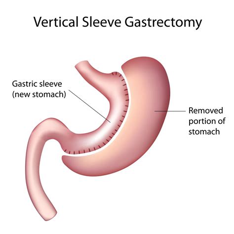 sleeve gastrectomie operatie chirurgie waregem