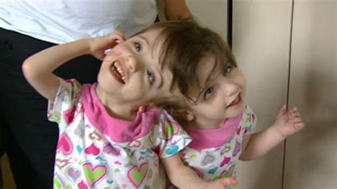 conjoined twins a medical wonder video abc news
