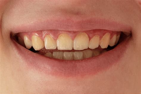 teeth whitening bespoke dental