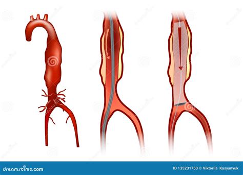 aneurysm cartoons illustrations vector stock images  pictures