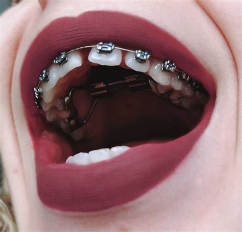 adult braces braces girls braces smile teeth braces cute braces